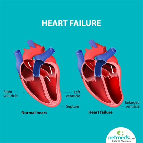 mild lv systolic impairment|what is severe lv impairment.